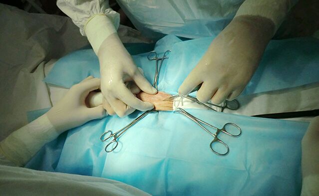 Üreme organındaki cerrahi, boyutunun artmasına yardımcı olacaktır